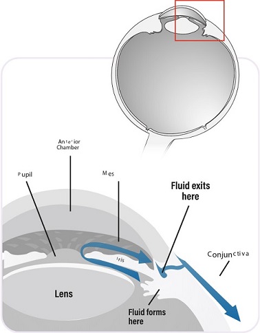 What-causes-Glaucoma